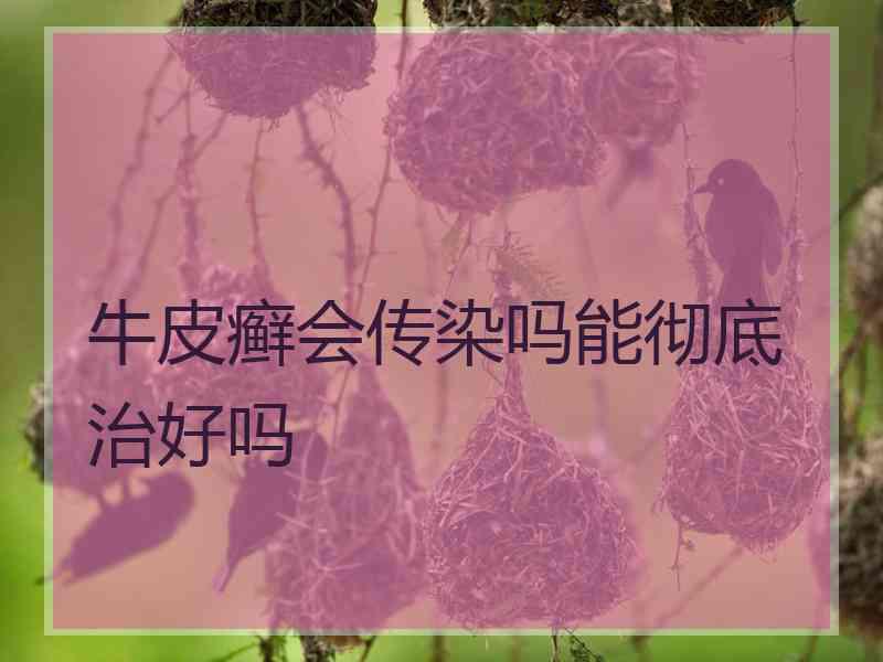 牛皮癣会传染吗能彻底治好吗